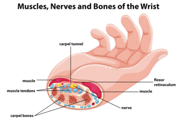 What Is Carpal Tunnel Syndrome Ultrasound Guided Injections