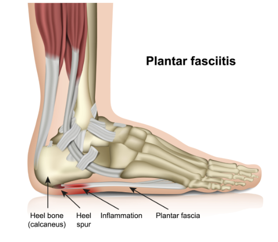 Plantar fascia (Heel) Pain - Ultrasound 