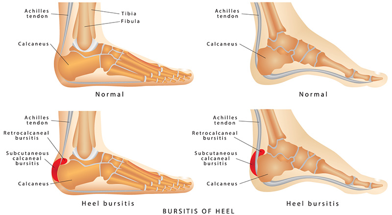 Bursitis of the Heel - What is it 