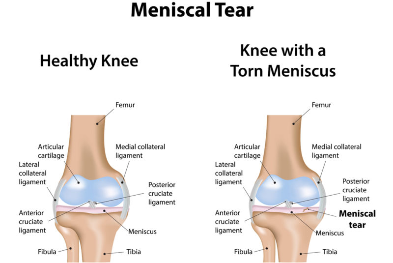 What is a meniscal tear? - Ultrasound Guided Injections