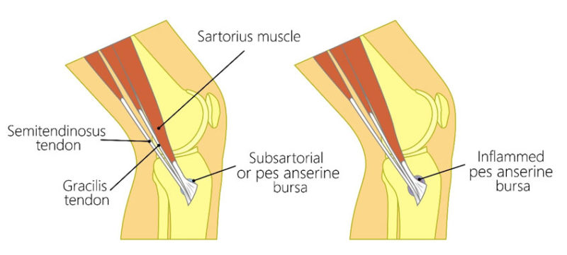 Pes Anserine Tendinopathy Bursitis Ultrasound Guided Injections