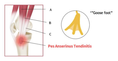 Pes Anserine Tendinopathy Bursitis Ultrasound Guided Injections