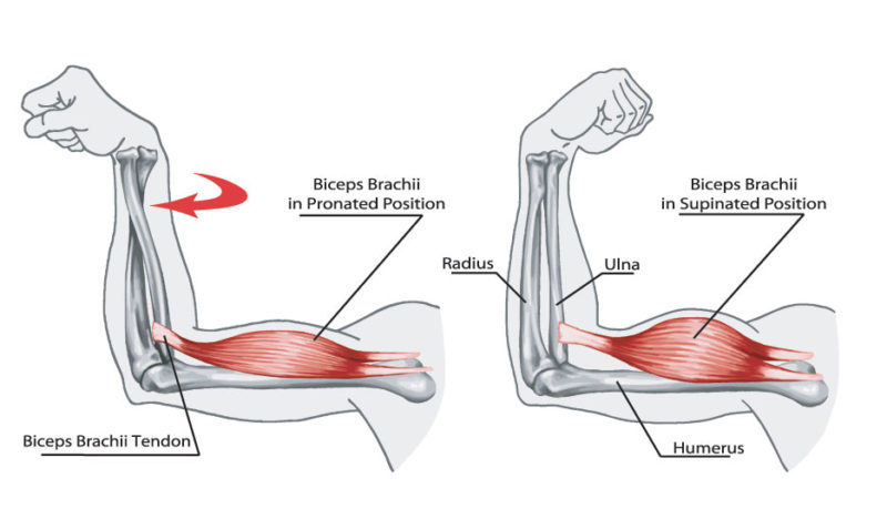 Distal biceps tendon injuries of the elbow - Ultrasound Guided Injections