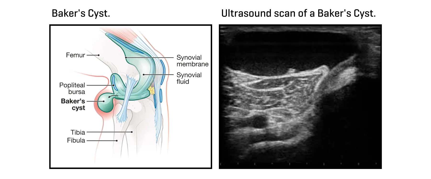 Ultrasound body scans of a baker's cyst